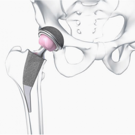 3D/Film - Animation - Visualisierung - Beger Design - METHA - Hüftprothese - Aesculap